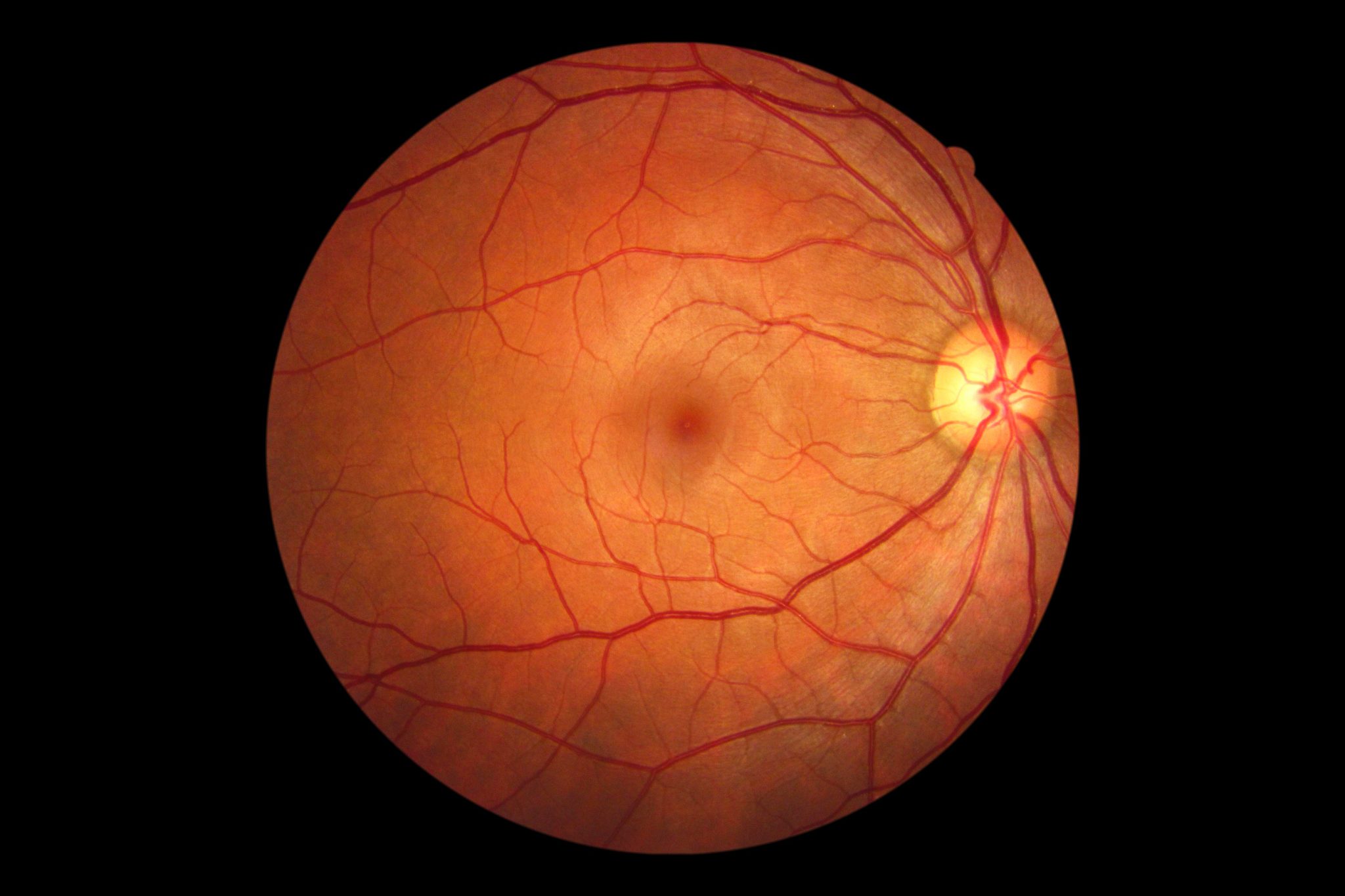 What Causes Retinal Tears and Detachments?