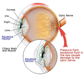 Glaucoma and High Blood Pressure