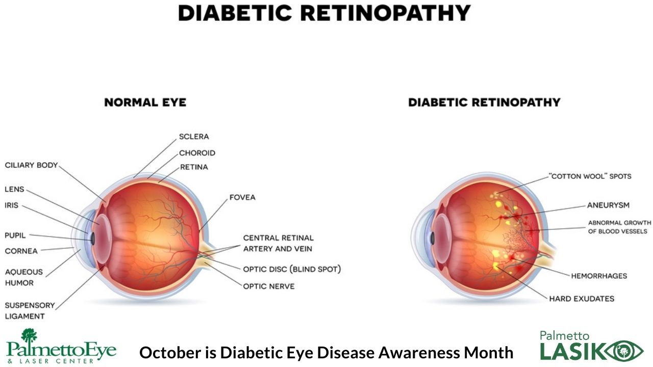 Protect Your Vision from Your Diabetes