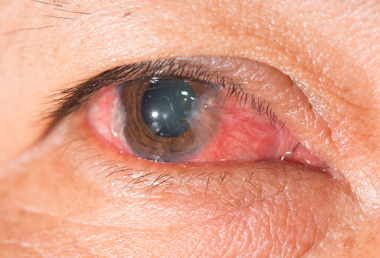 PTERYGIUM EYE TREATMENT